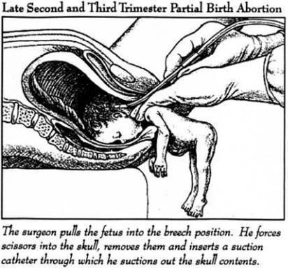 Partial Birth Abortion photo partial-birth_abortion1_zpsf406b8be.jpg